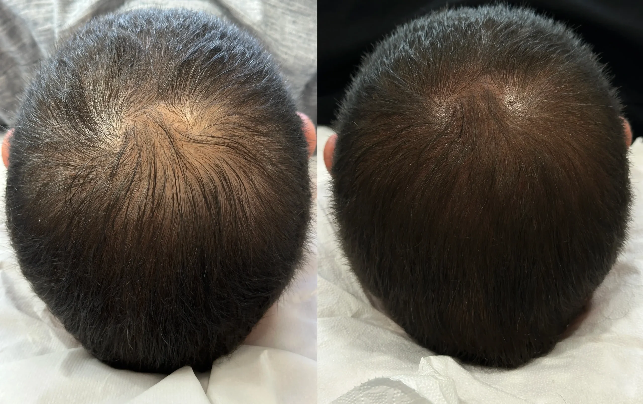 riempimento capelli folti tatuaggio pescara tricopigmentazione pescara kali's kiss tattoo