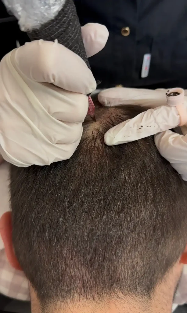 tricopigmentazione: tatuaggio capelli pescara effetto riempimento kali's kiss tattoo