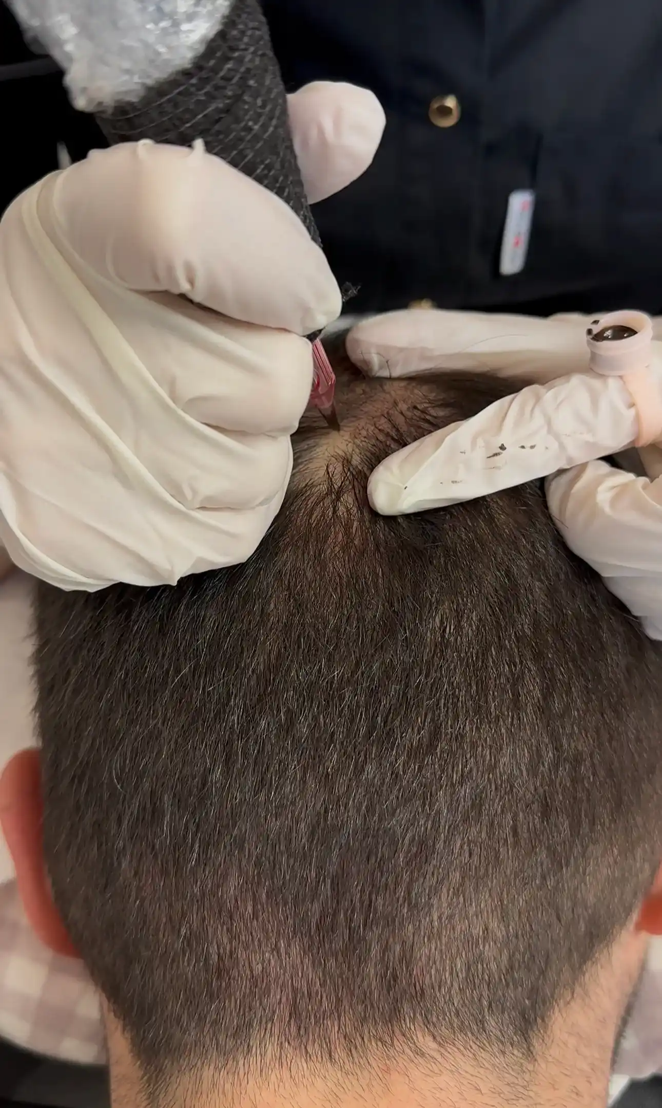 tricopigmentazione: tatuaggio capelli pescara effetto riempimento kali's kiss tattoo