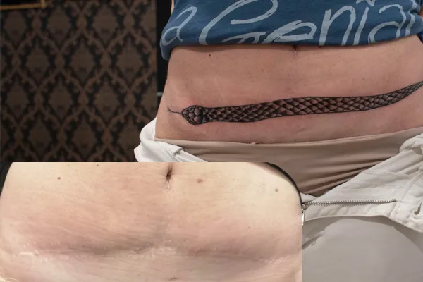 cover up cicatrici tatuaggio pescara kali's kiss tattoo