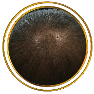 tricopigmentazione effetto riempimento pescara kali's kiss tattoo